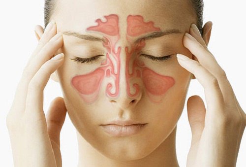 Cómo tratar la sinusitis con remedios caseros