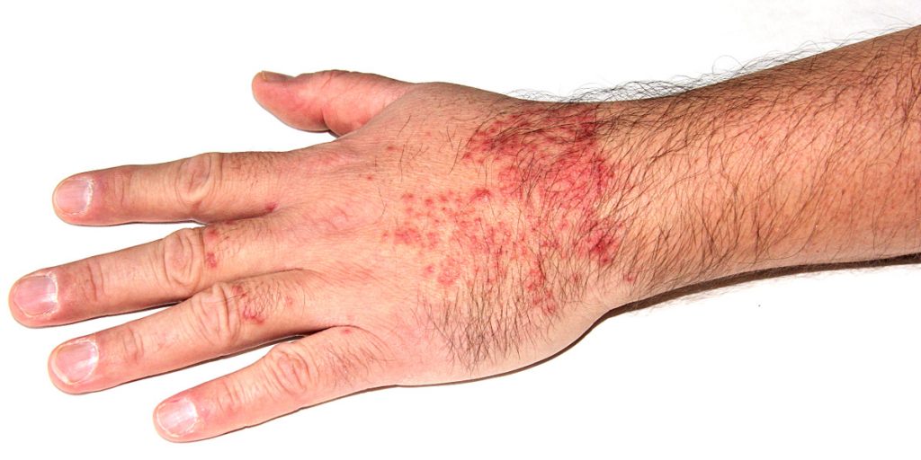 cercarial-dermatitis-trichobilharzia-szidati-c-mo-lo-puedo-hacer