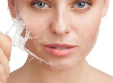 Cómo prevenir el acné 3