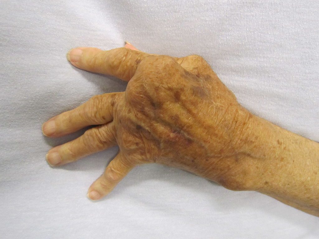 ¿Cómo tratar la artritis?